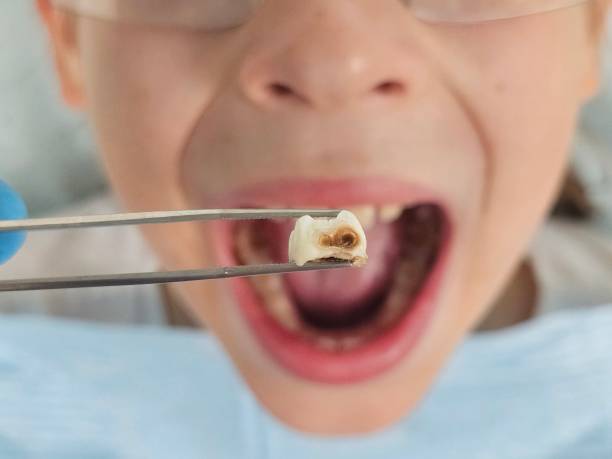 Best Chipped Tooth Repair Near Me  in Hawi, HI